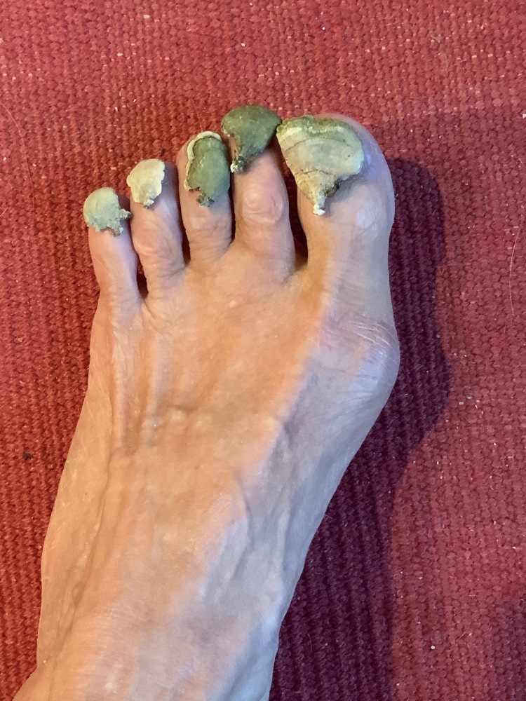 A foot on a carpet with small shelf fungus on toe nails - a surreal image that intends to imply interconnectedness of body and world